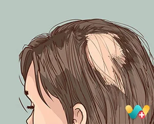 Alopecia Areata