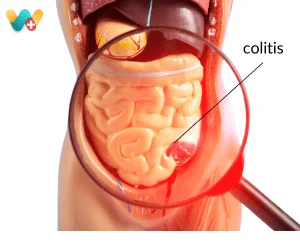 Colitis