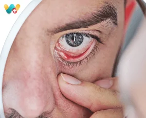 Dry Eye