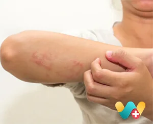 Eczema