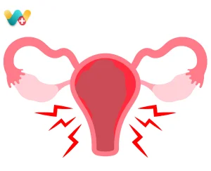 Endometriosis