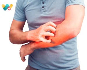 itching skin