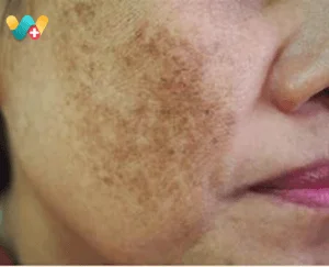 melasma