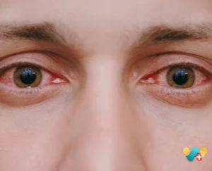 Redness in Eyes 